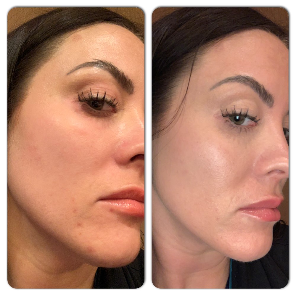 Melasma Treatment Before & After Duluth, MN
