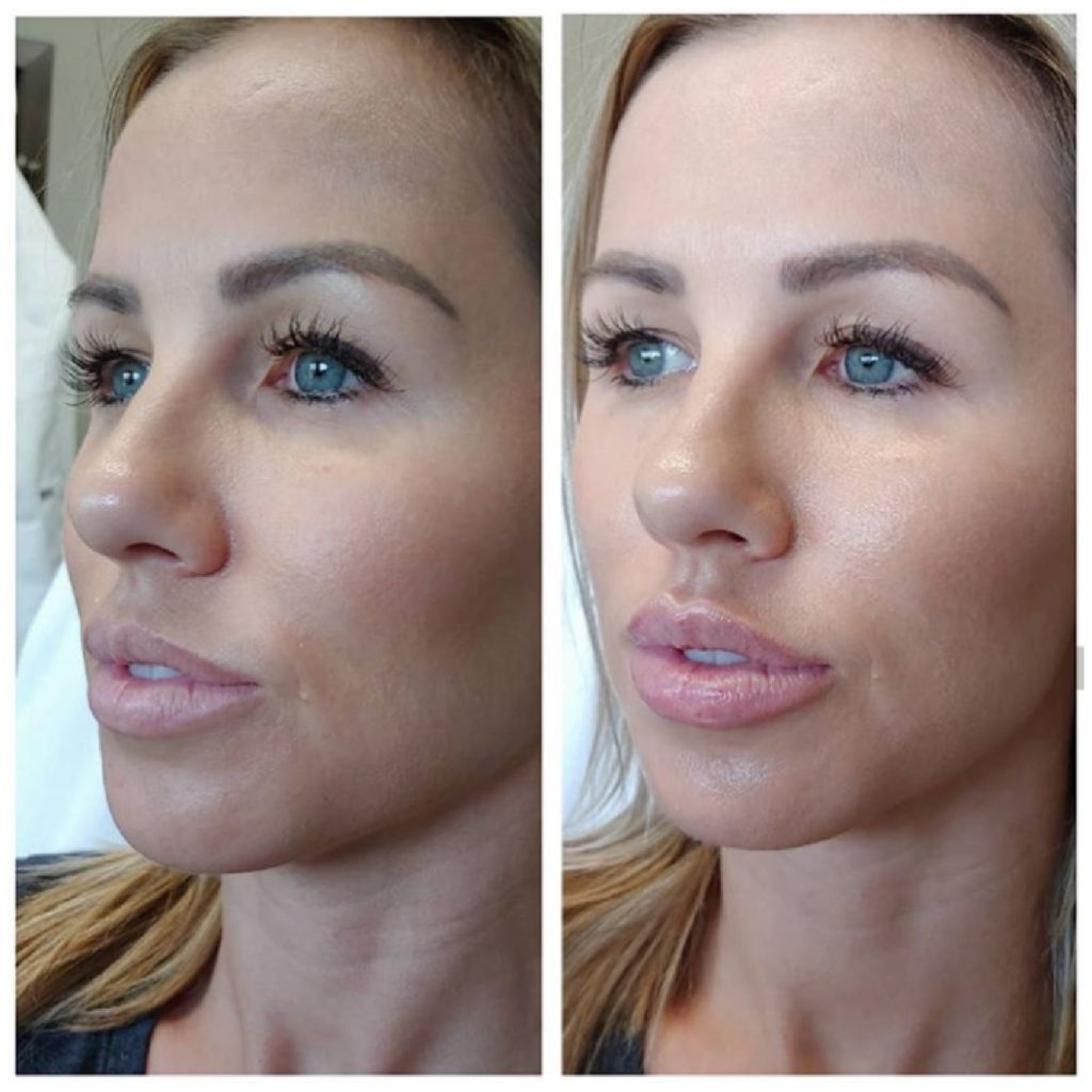Juvederm Ultra Plus XC Duluth Lip Fillers Northern