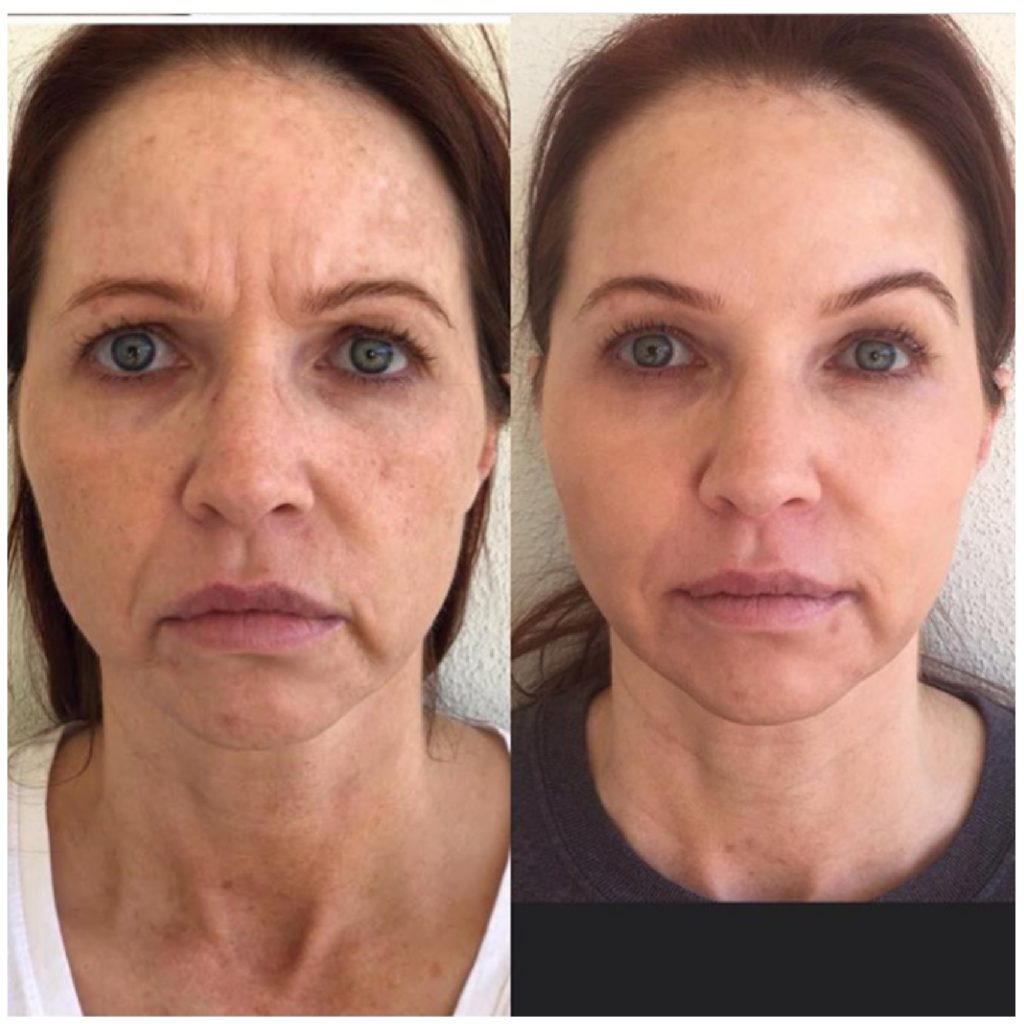 Voluma, JuvedermUltra, & Botox- (Cheeks, Marionette, & Forehead)-Before & After-Duluth, MN