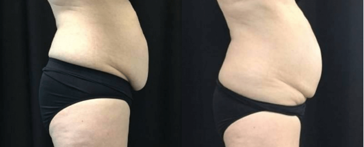 Coolsculpting Duluth