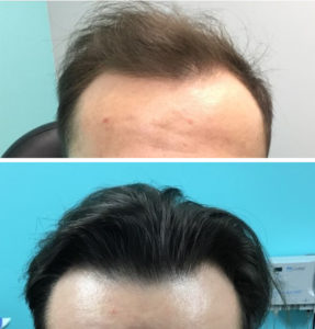 PRP For Hair Loss Duluth | Hair Restoration Northern Minnesota | Twin Ports  Dermatology | Duluth, MN