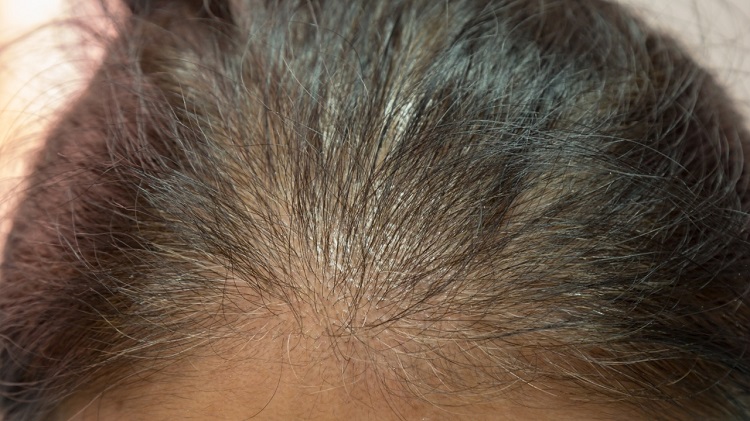 What to Do for Thinning Hair? | Duluth Thinning Hair | Twin Ports  Dermatology | Duluth, MN