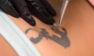Laser Tattoo Removal Northern Minnesota