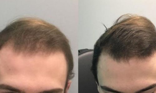 Duluth PRP for Hair Loss